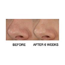 Clinique Blackhead Solutions Self Heating Blackhead Extractor