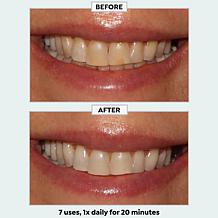 Intelliwhite Blue32 Whitening Kit