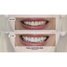 Intelliwhite Supersize Prostrips Teeth Whitening Kit Auto-Ship®