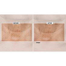 Isomers Diamond Peptide Spicule Exfoliating Peel