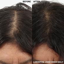 Keranique 120 Day Hair Regrowth Foam Bundle