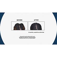 Keranique 90-Day Hair Regrowth Volumizing Kit