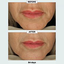 Metamorphosis Light Therapy LushLips Transformation Clinically Desi...