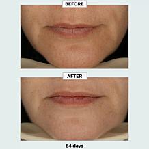 Metamorphosis Light Therapy LushLips Transformation LED Lip + Perio...