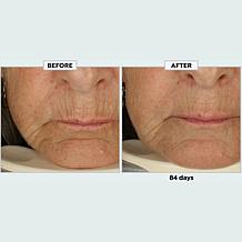 Metamorphosis Light Therapy LushLips Transformation LED Lip + Perio...