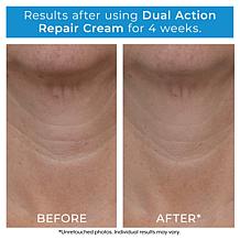Plexaderm Rapid Reduction Serum 2-pack & Dual Action Cream