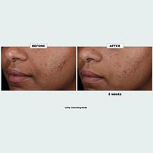 Sharper Image Revel LED Light Therapy Face Mask