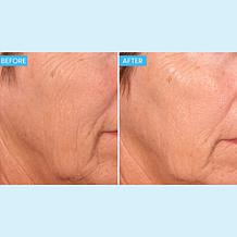 SKINN 2-pack Deep Wrinkle Protocol Creme Reverse Auto-Ship®