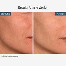 SKINN Non-Negotiables Resurfacing Pads & Headband Duo - Auto-Ship®