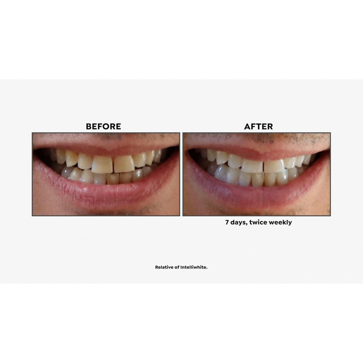 Hismile Review by a Real Dentist #shorts #patienteducation #teethwhitening  